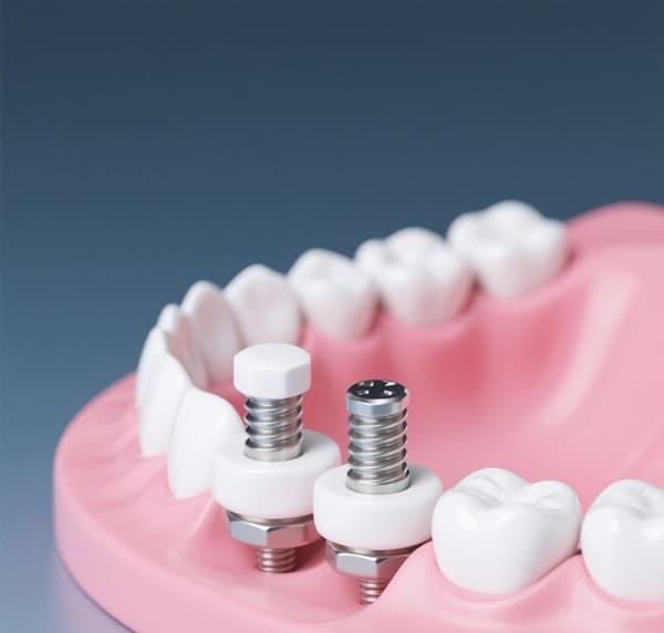 Zirconia Implants vs Titanium Implants: Which Is Better?